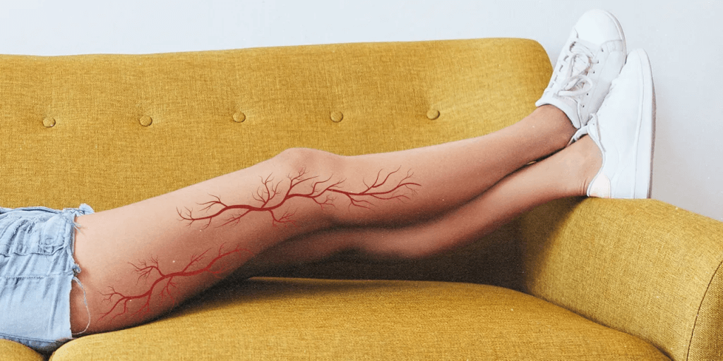 What Happens If You Leave Spider Veins Untreated, and the Best Fixes